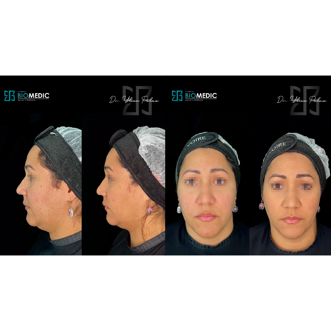 Armonización Facial