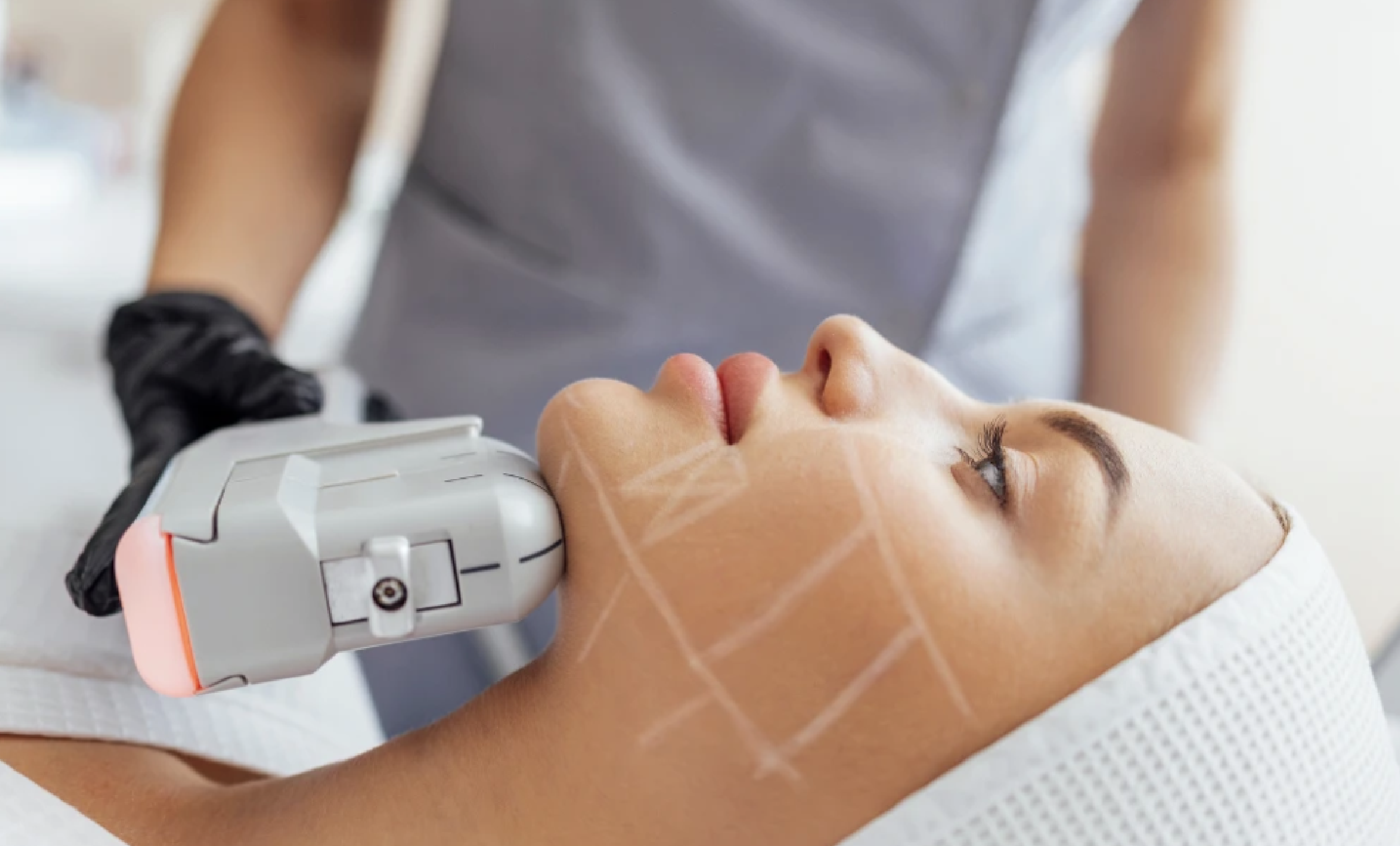 HIFU facial