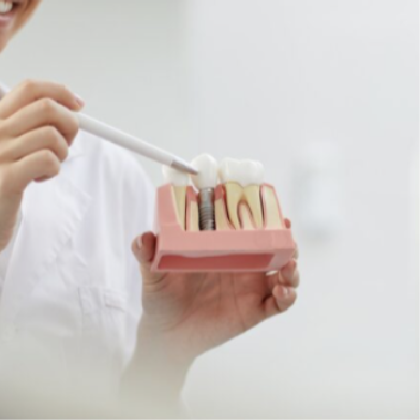 Implantes